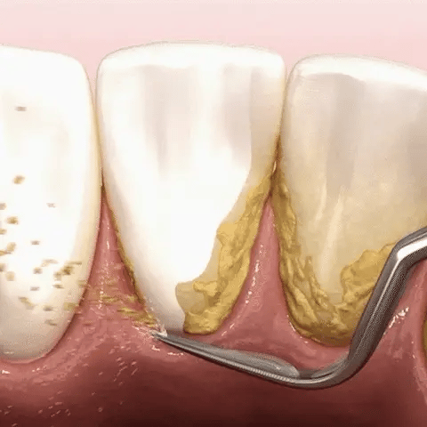 جهاز إزالة الجير